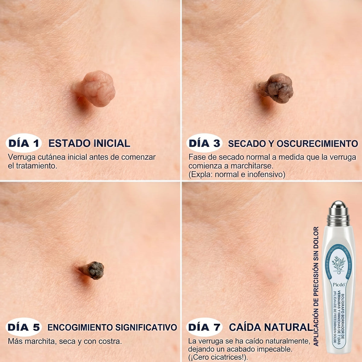 🔥🎁 ¡ÚLTIMAS 5 UNIDADES! Aprovecha un 30% DE DESCUENTO adicional en 𝐏𝐢𝐜𝐝𝐨® Borrador de Verrugas y Manchas — ¡Hasta que dure el stock!