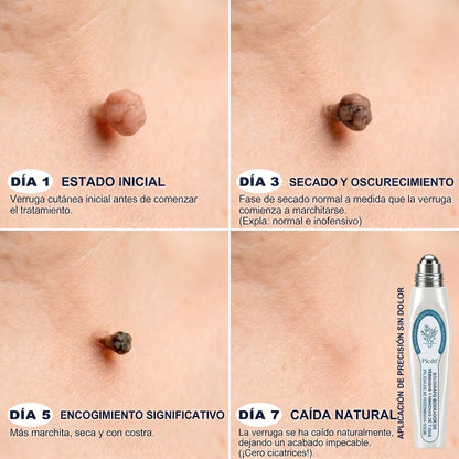 🔥🎁 ¡ÚLTIMAS 5 UNIDADES! Aprovecha un 30% DE DESCUENTO adicional en 𝐏𝐢𝐜𝐝𝐨® Borrador de Verrugas y Manchas — ¡Hasta que dure el stock!
