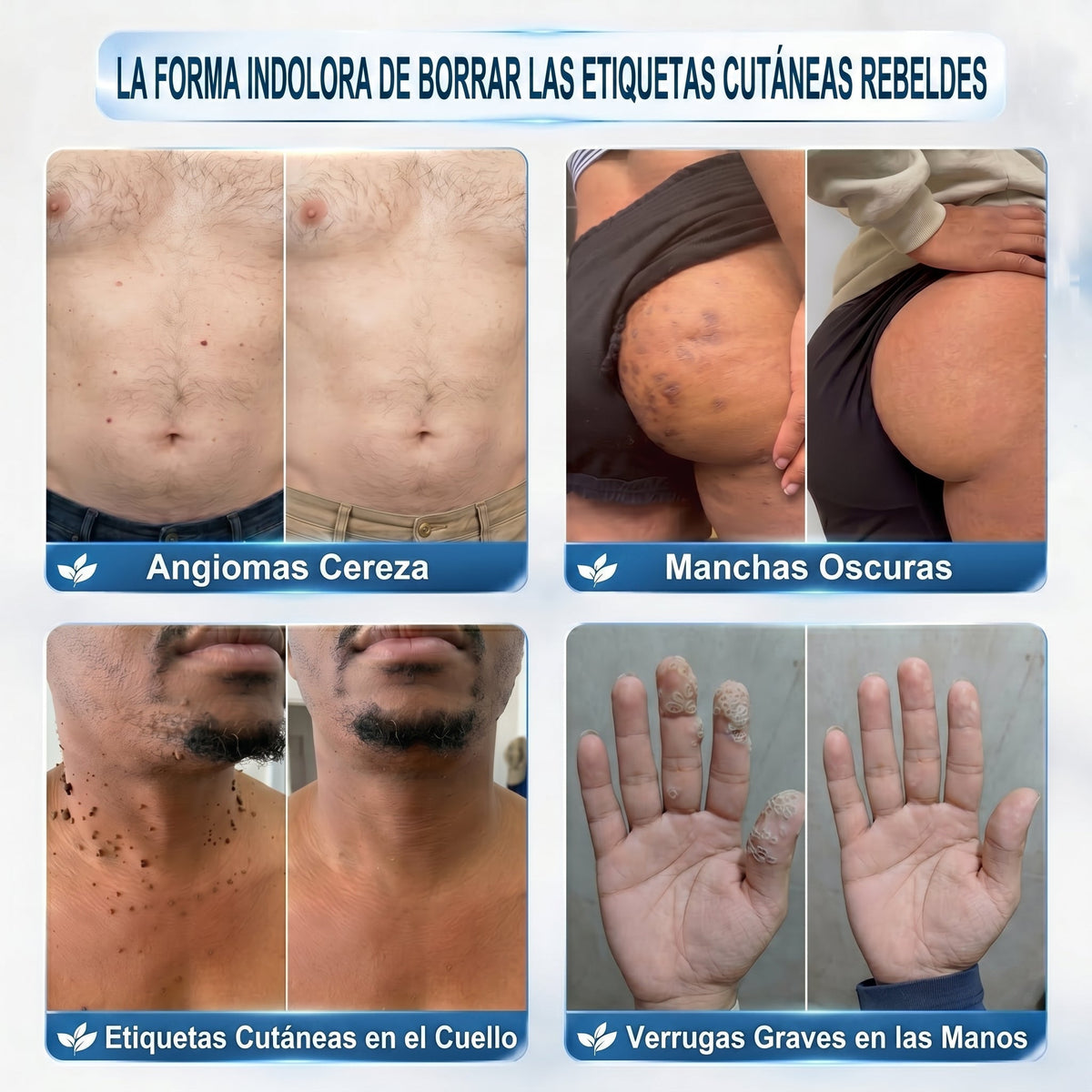 🔥🎁 ¡ÚLTIMAS 5 UNIDADES! Aprovecha un 30% DE DESCUENTO adicional en 𝐏𝐢𝐜𝐝𝐨® Borrador de Verrugas y Manchas — ¡Hasta que dure el stock!