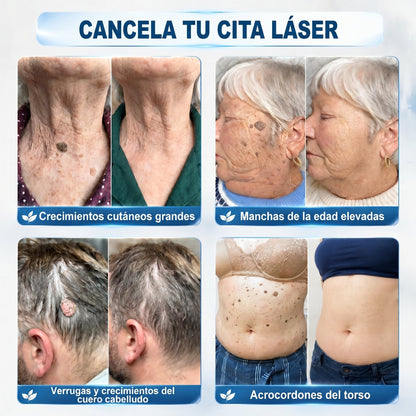 🔥🎁 ¡ÚLTIMAS 5 UNIDADES! Aprovecha un 30% DE DESCUENTO adicional en 𝐏𝐢𝐜𝐝𝐨® Borrador de Verrugas y Manchas — ¡Hasta que dure el stock!